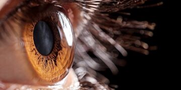 Katarakt Ve Kırma Kusurlarınızda Trifokal Mercekler