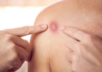 Maymun Çiçeği Virüsü