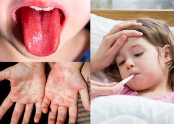 Strep A Enfeksiyonu Artış Gösteriyor! Bu Belirtilere Dikkat