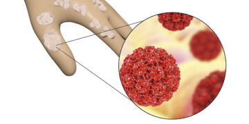 Hpv Enfeksiyon Riskinizi Düşürecek 8 Önlem