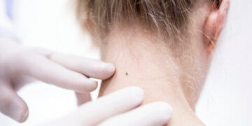 Deri Kanseri Hakkında Bilinen 6 Yaygın Yanlış