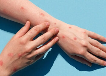 Maymun Çiçeği Virüsü Pandemi Etkisi Yaratır Mı?