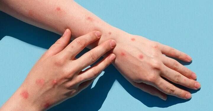 Maymun Çiçeği Virüsü Pandemi Etkisi Yaratır Mı?