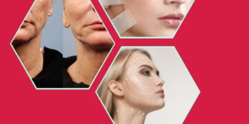 Ameliyatsız Yüz Germe: Yenilikçi Tekniklerle Ameliyatsız Gençleşme