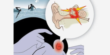 Tatil Sezonunun Yaygın Rahatsızlığı: Dış Kulak İltihabı