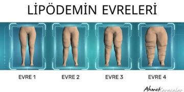 Kilo Veremiyorsanız Suçlu İradeniz Değil, Lipödem Olabilir