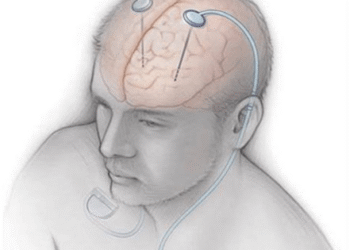 Parkinson Hastalığı Tedavisinde ‘Beyin Pili’ Yöntemi