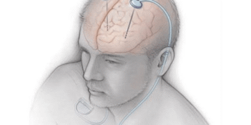 Parkinson Hastalığı Tedavisinde ‘Beyin Pili’ Yöntemi