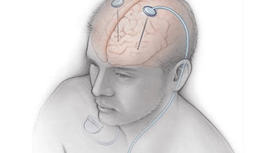 Parkinson Hastalığı Tedavisinde ‘Beyin Pili’ Yöntemi