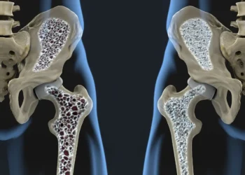 Osteoporoz Riskini Azaltacak 7 Önlem