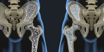 Osteoporoz Riskini Azaltacak 7 Önlem