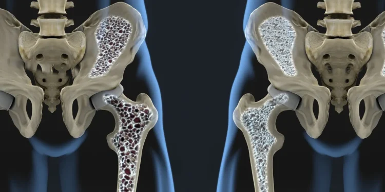 Osteoporoz Riskini Azaltacak 7 Önlem