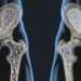 Osteoporoz Riskini Azaltacak 7 Önlem